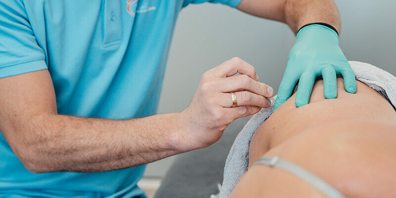 Positieve effecten dry needling in veenendaal patient krijgt een dry needling in Veenendaal behandeling